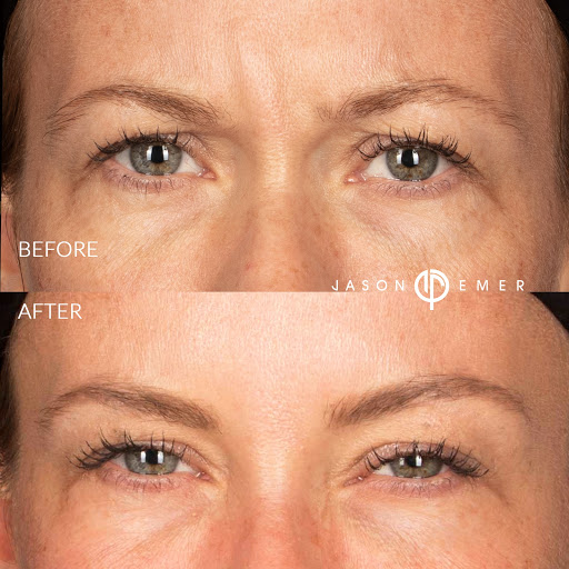 Chemical Brow Lifts