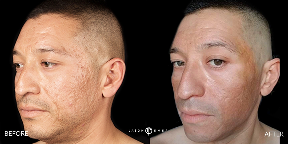 Acne and general scar treatment | Before and After | Cosmetic Dermatologist | Dr. Jason Emer MD | Beverly Hills, CA