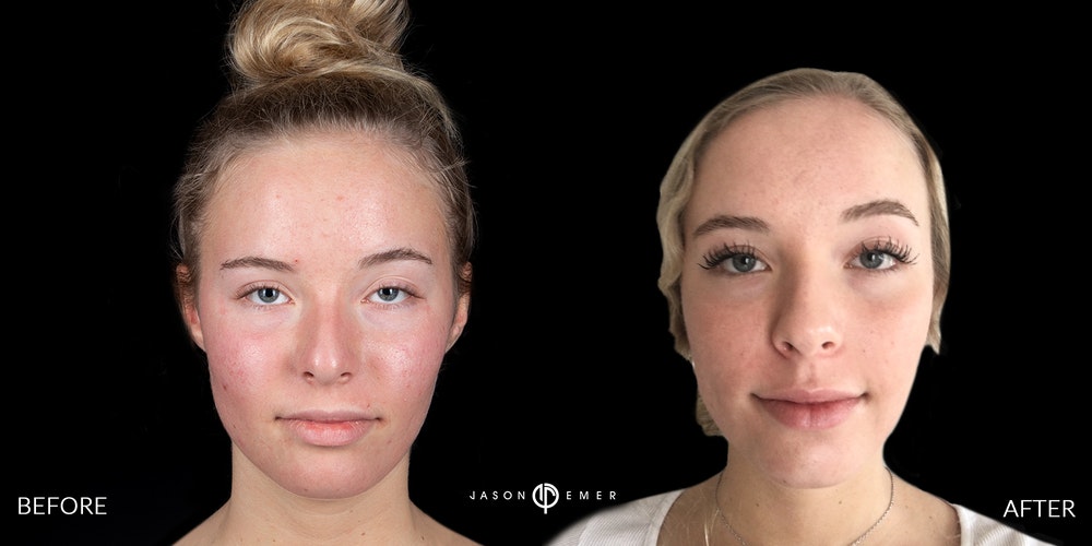 Acne Scar Before and After Photo Female Dr. Jason Emer