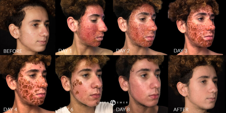 Acne scar best before and after los angeles beverly hills