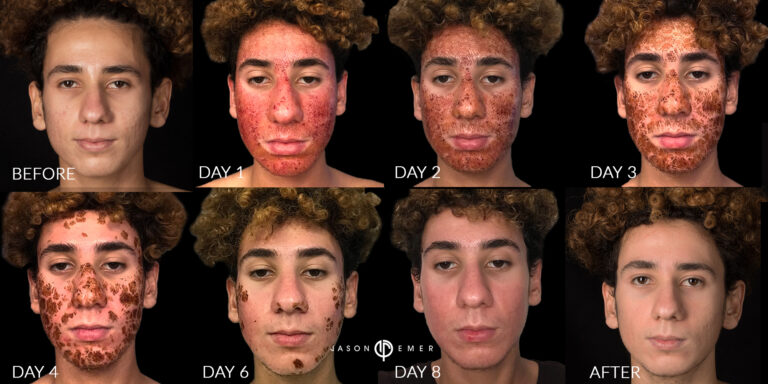 Acne scar best before and after los angeles beverly hills