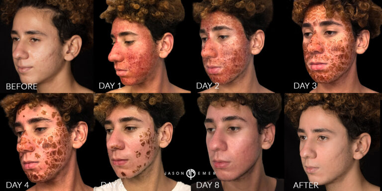 Acne scar best before and after los angeles beverly hills