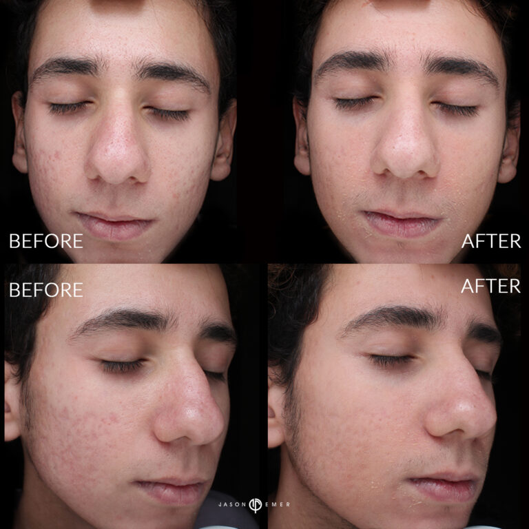 Acne scar best before and after los angeles beverly hills