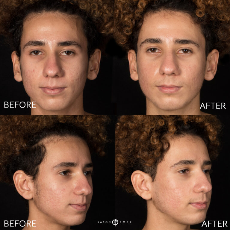 Acne scar best before and after los angeles beverly hills