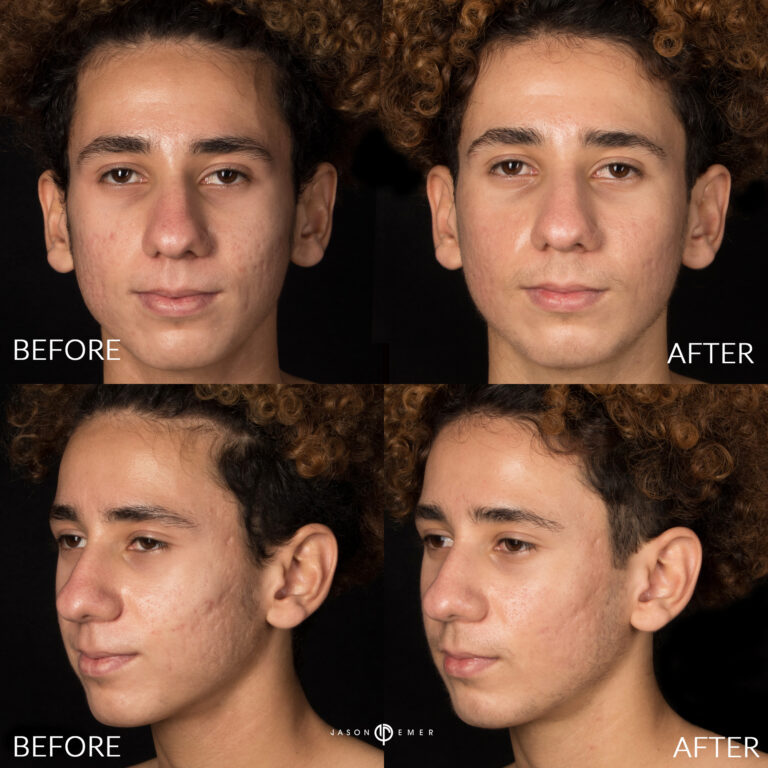 Acne scar best before and after los angeles beverly hills