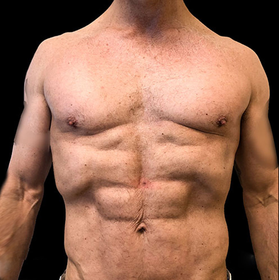 Emer-Male-HD-Lipo-After.jpg