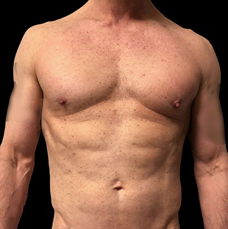 Emer-Male-HD-Lipo-Before.jpg