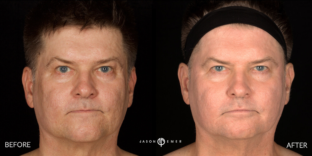 CO2 and Microneedling For Acne Scars Beverly Hills