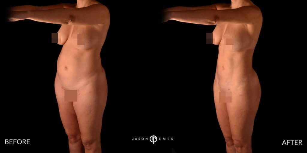 360 hd lipo on the entire body | Before and After | Cosmetic Dermatologist | Dr. Jason Emer MD | Beverly Hills, CA