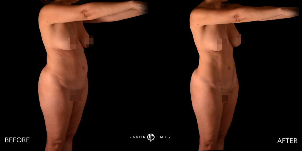 360 hd lipo on the entire body | Before and After | Cosmetic Dermatologist | Dr. Jason Emer MD | Beverly Hills, CA