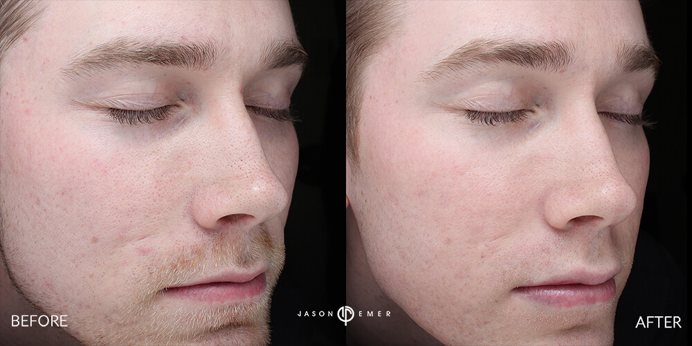 Acne scar best before and after los angeles beverly hills