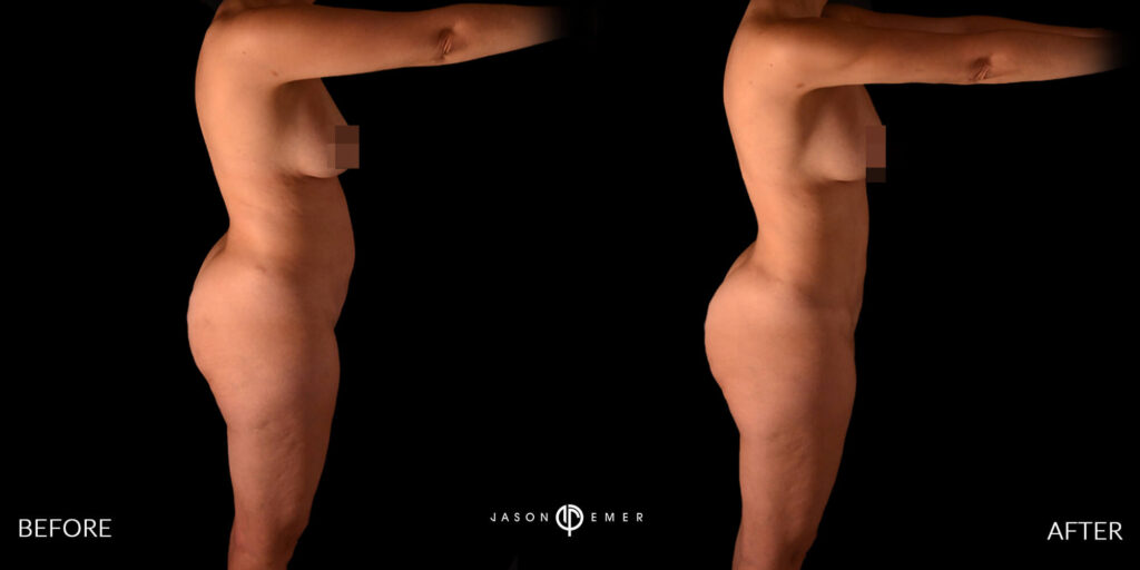 360 hd lipo on the entire body | Before and After | Cosmetic Dermatologist | Dr. Jason Emer MD | Beverly Hills, CA