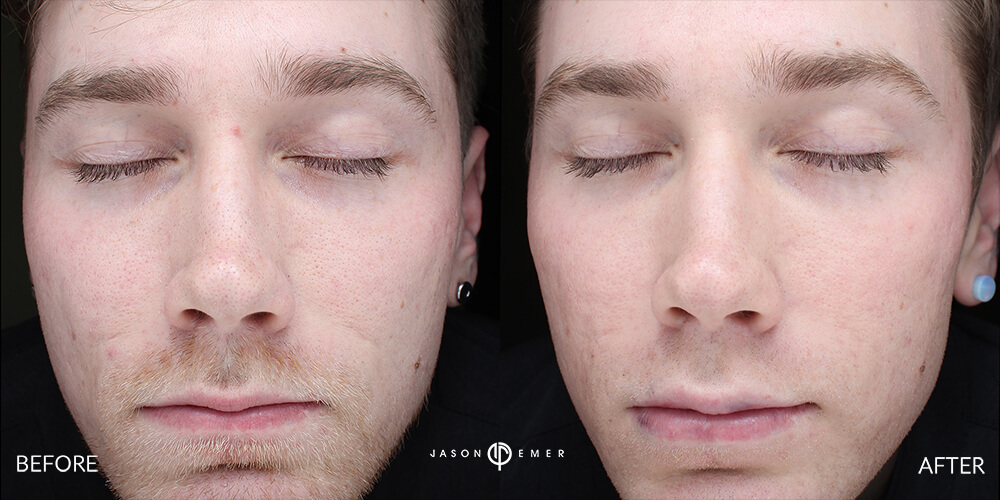 Acne scar best before and after los angeles beverly hills