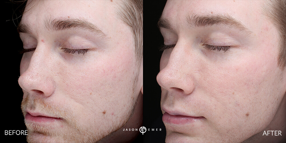 Acne scar best before and after los angeles beverly hills