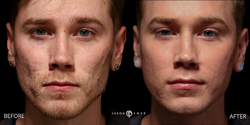 Acne scar best before and after los angeles beverly hills