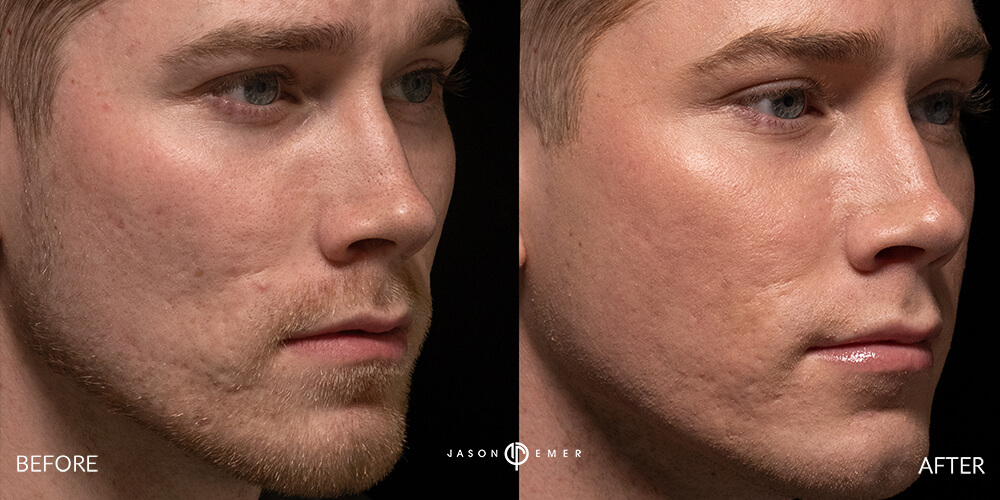 Acne scar best before and after los angeles beverly hills