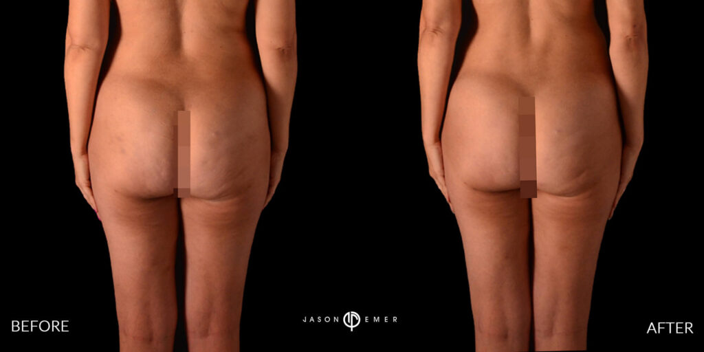 360 hd lipo on the entire body | Before and After | Cosmetic Dermatologist | Dr. Jason Emer MD | Beverly Hills, CA