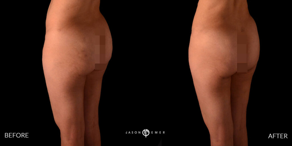 360 hd lipo on the entire body | Before and After | Cosmetic Dermatologist | Dr. Jason Emer MD | Beverly Hills, CA