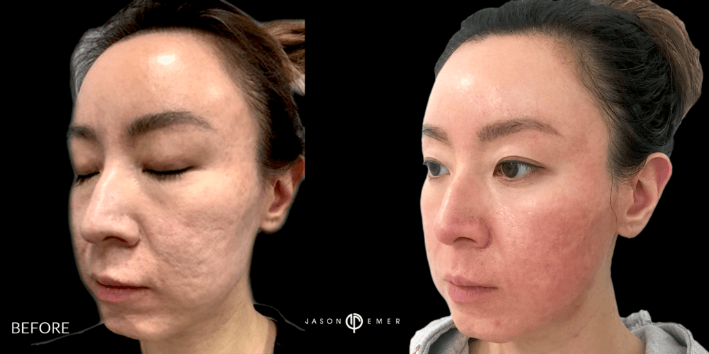 CO2 and Microneedling For Acne Scars Beverly Hills