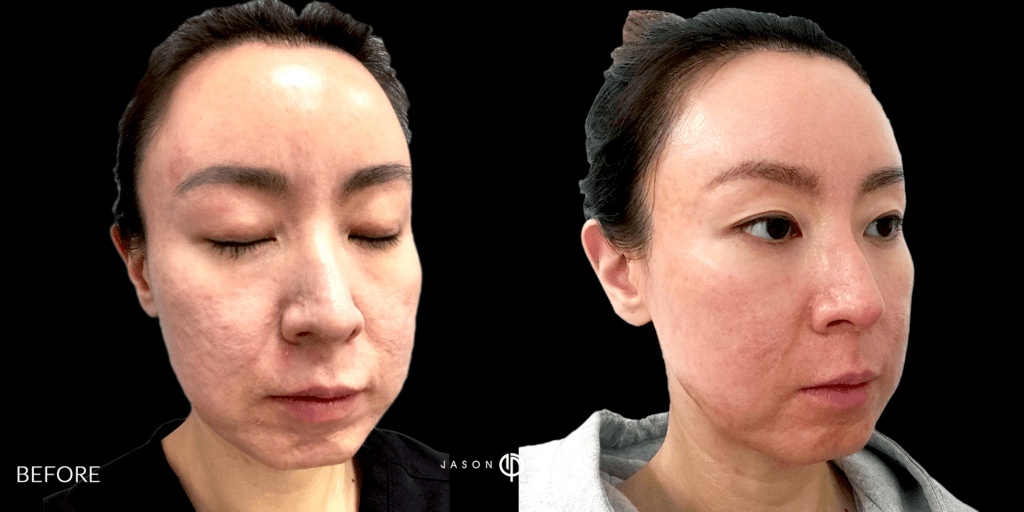 CO2 and Microneedling For Acne Scars Beverly Hills
