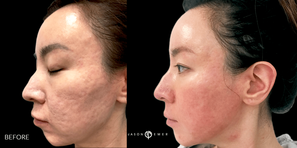 CO2 and Microneedling For Acne Scars Beverly Hills