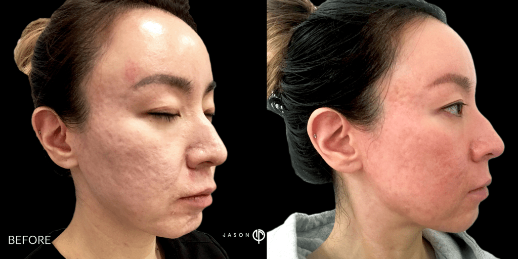 CO2 and Microneedling For Acne Scars Beverly Hills