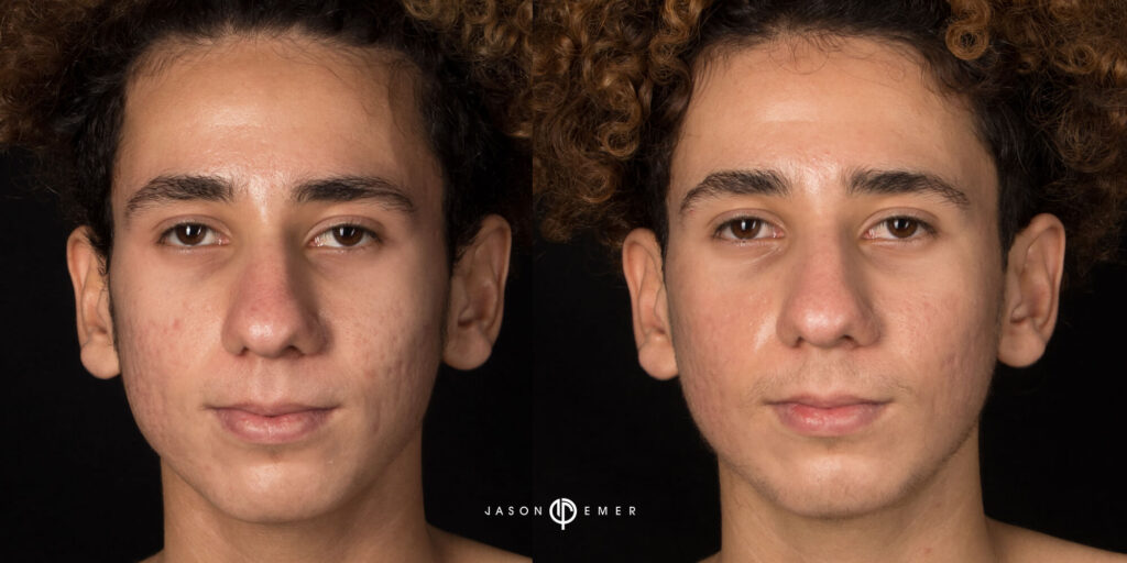 Acne scar best before and after los angeles beverly hills