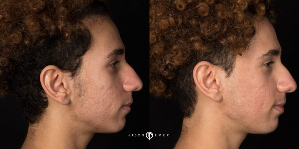 Acne scar best before and after los angeles beverly hills