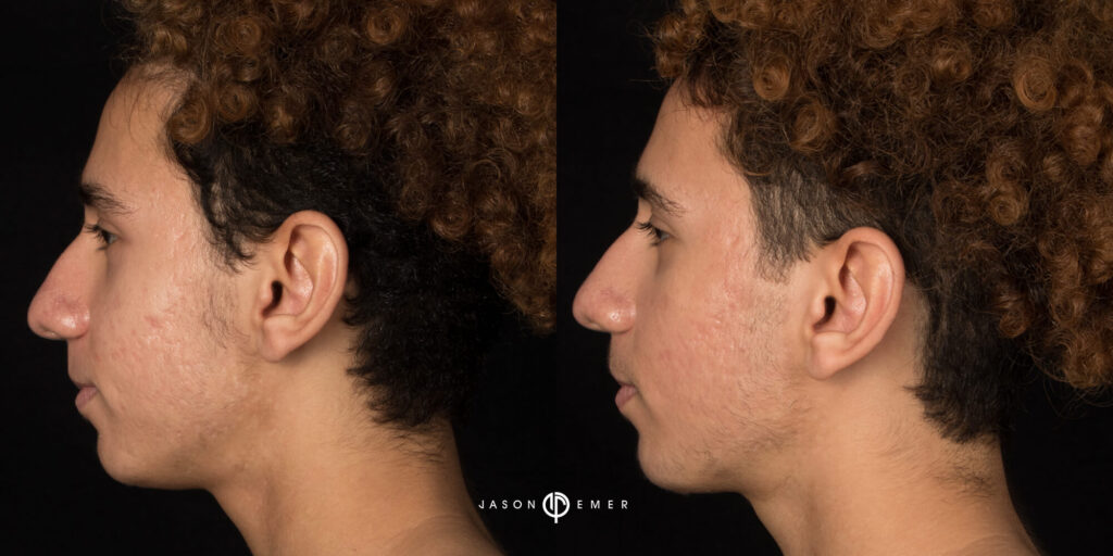 Acne scar best before and after los angeles beverly hills