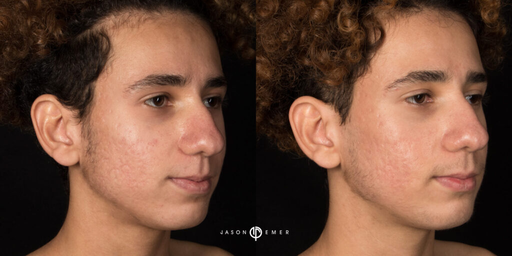 Acne scar best before and after los angeles beverly hills