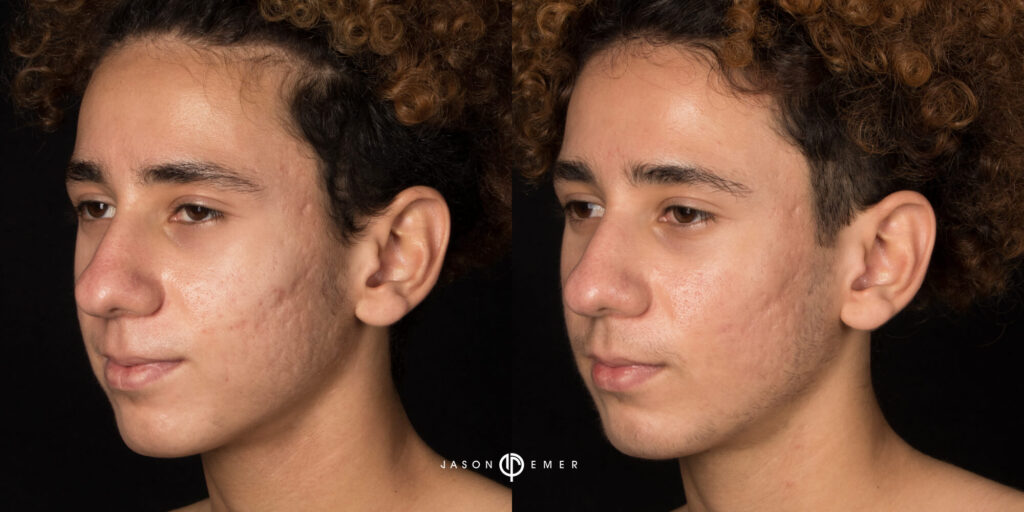 Acne scar best before and after los angeles beverly hills