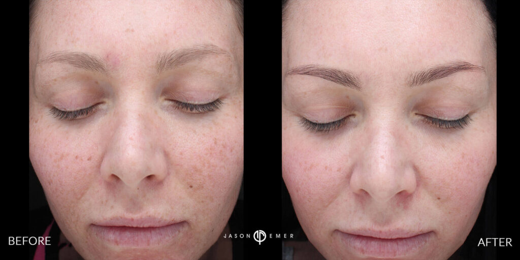 CO2 and Microneedling For Acne Scars Beverly Hills