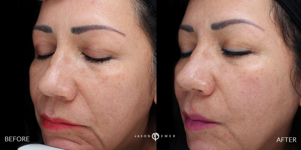 CO2 and Microneedling For Acne Scars Beverly Hills