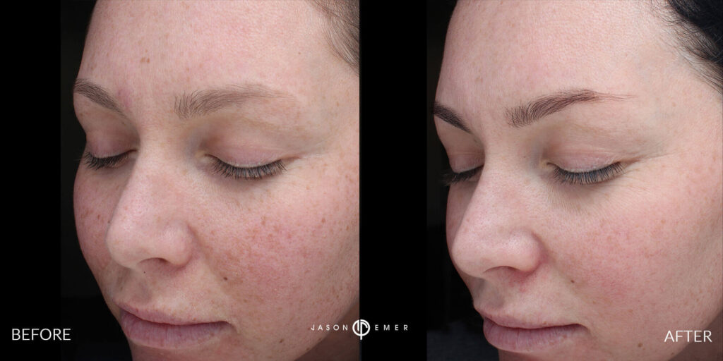 CO2 and Microneedling For Acne Scars Beverly Hills