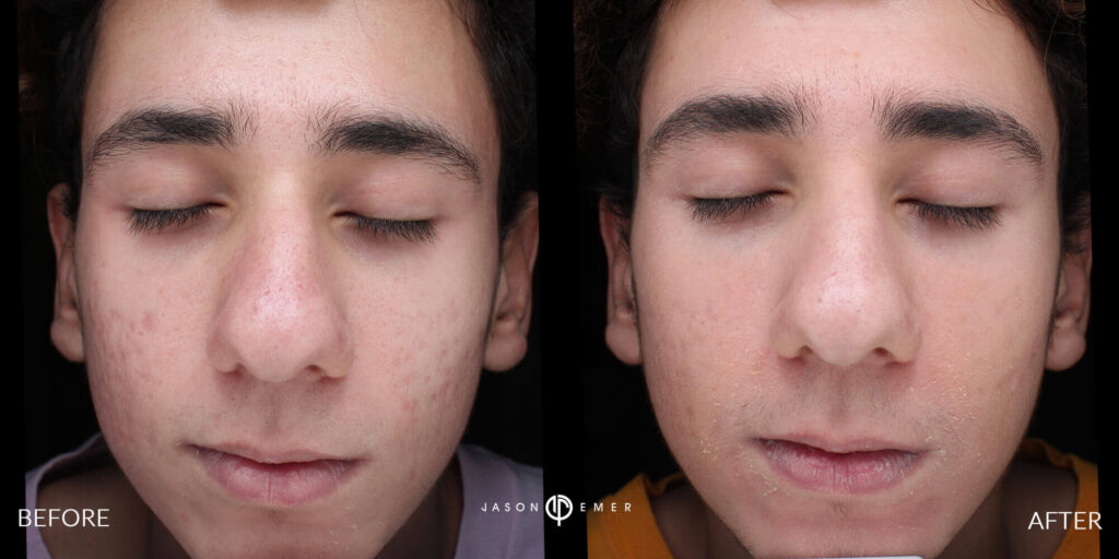 Acne scar best before and after los angeles beverly hills