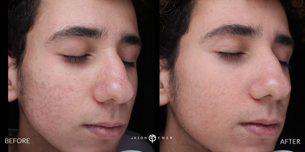 Acne scar best before and after los angeles beverly hills