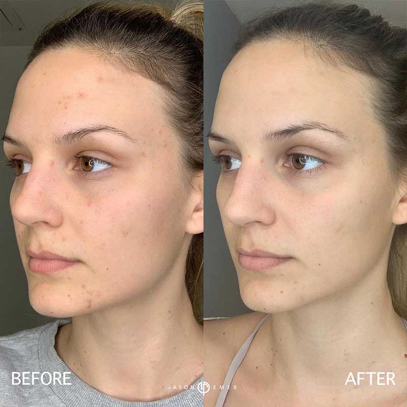 Aerify Complexion Kit | Before and After | Dr. Jason Emer MD | | Beverly Hills, CA