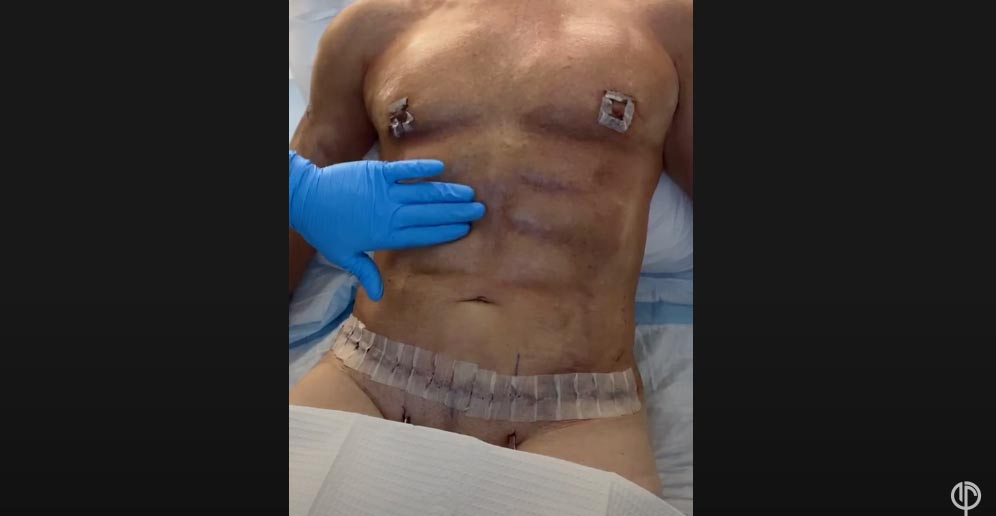 3-Male-Tummy-Tuck-Massage-Post-360-HD-Lipo