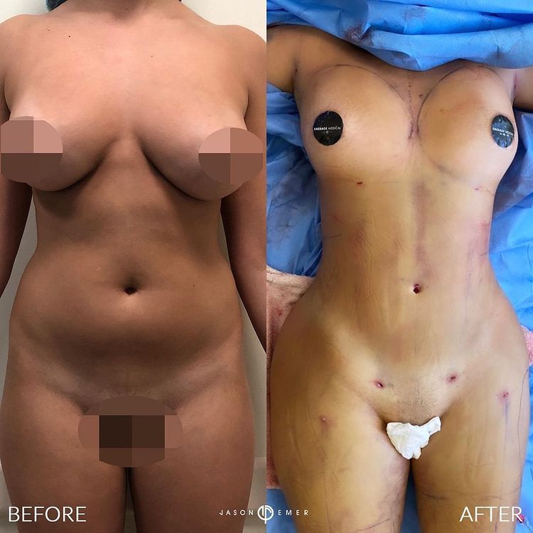 360 HD Lipo Beverly Hills Female Patient 2 - 1