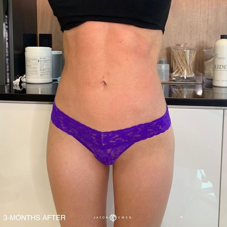 360 HD Lipo Beverly Hills Female Patient 2 - 2