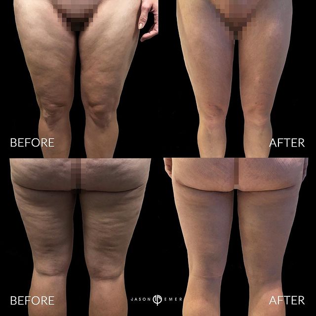 360 HD Lipo Beverly Hills Female Patient 360 HD-LIPO THIGH + INTERNAL HEATING + SPIRAL LIFT⁣ 3-1