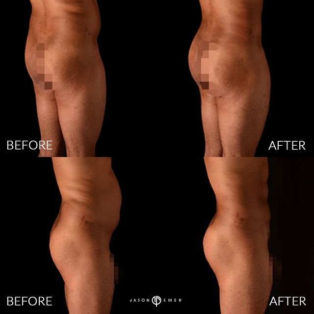 360 HD Lipo Beverly Hills Male Patient 2 - 1