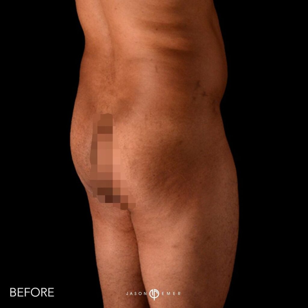 360 HD Lipo Beverly Hills Male Patient 2 - 2