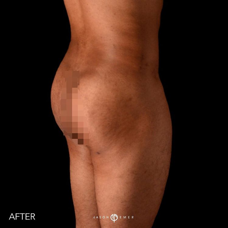 360 HD Lipo Beverly Hills Male Patient 2 - 3