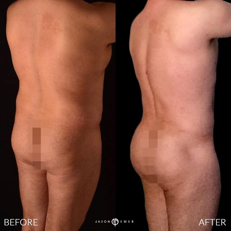 360 HD Lipo Beverly Hills Male Patient 3-1