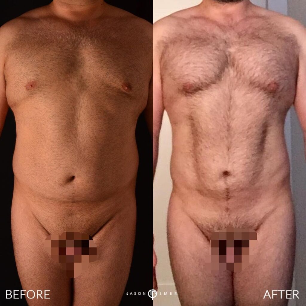 360 HD Lipo Beverly Hills Male Patient 3-2