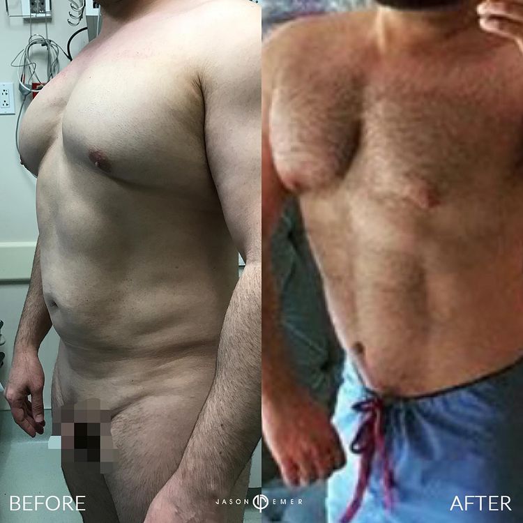 360 HD Lipo Beverly Hills Male Patient 3-3