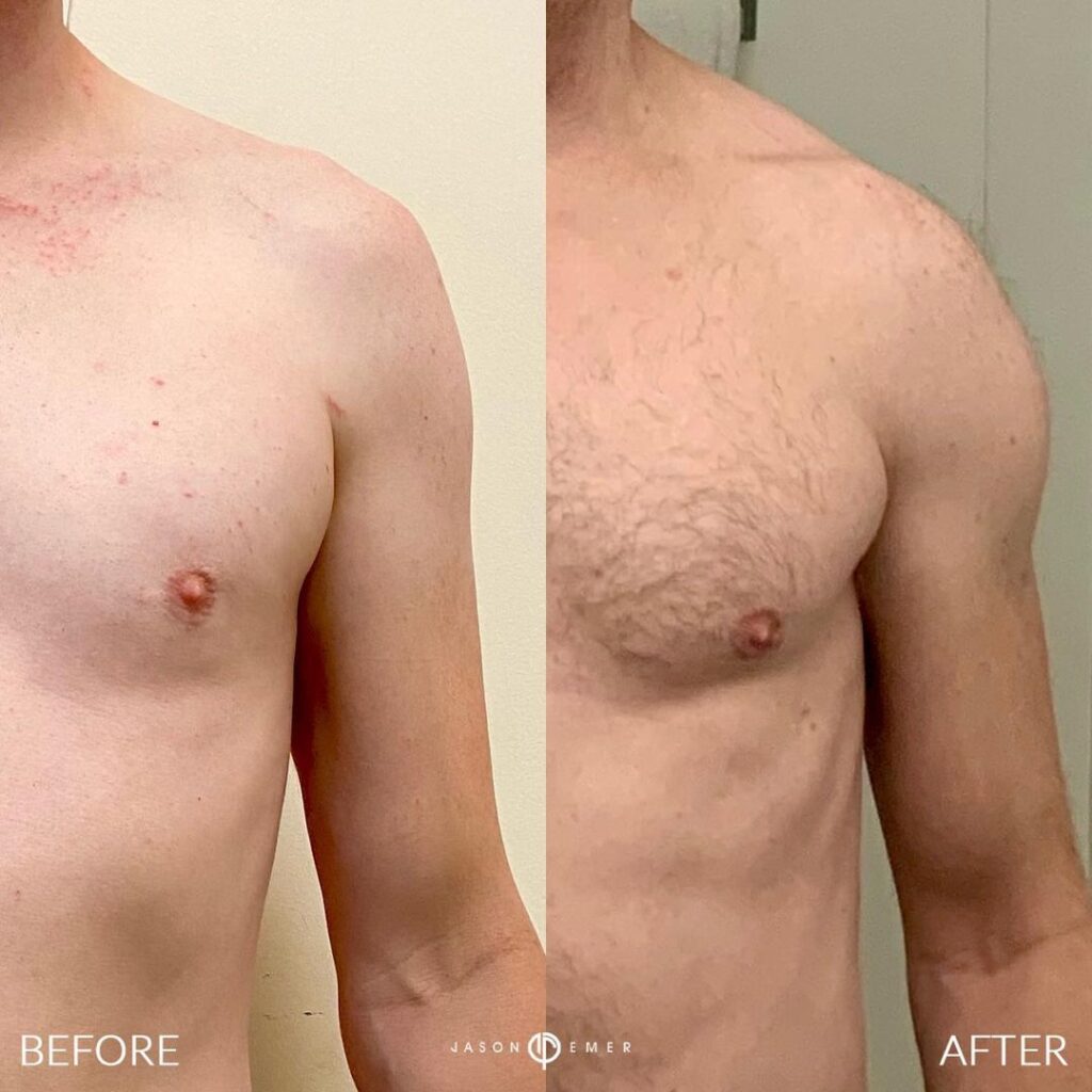 360 HD Lipo Beverly Hills Male Patient 7 - 1