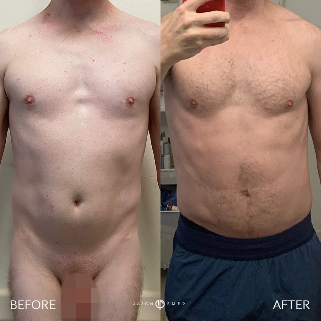 360 HD Lipo Beverly Hills Male Patient 7 - 3