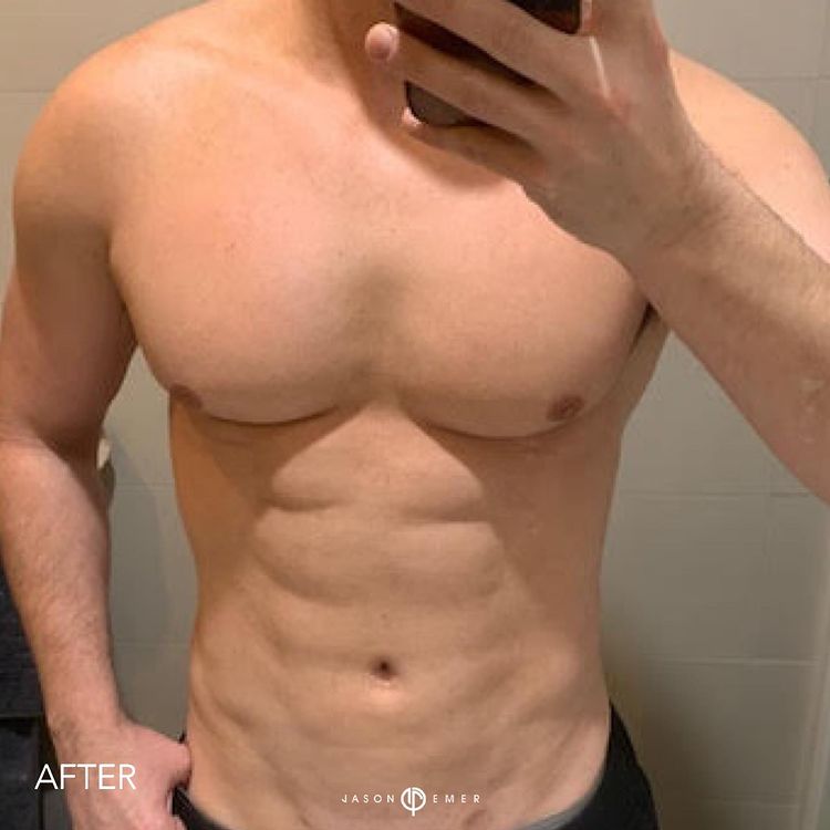 360 HD Lipo Male After